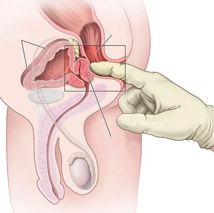 Prostate massage for prostatitis treatment